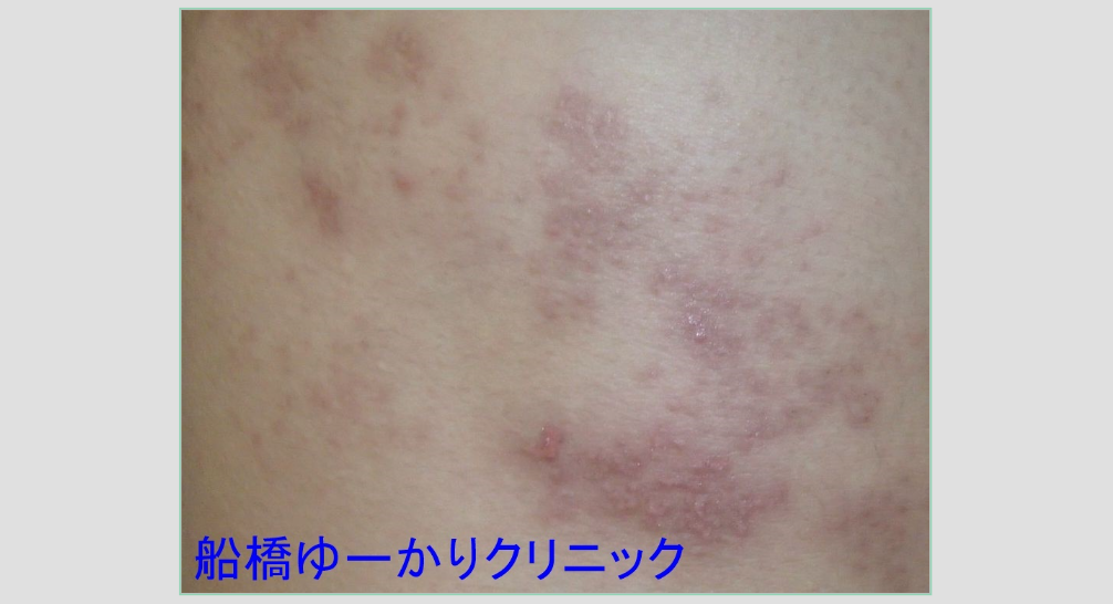 右胸部帯状疱疹 内服10日後