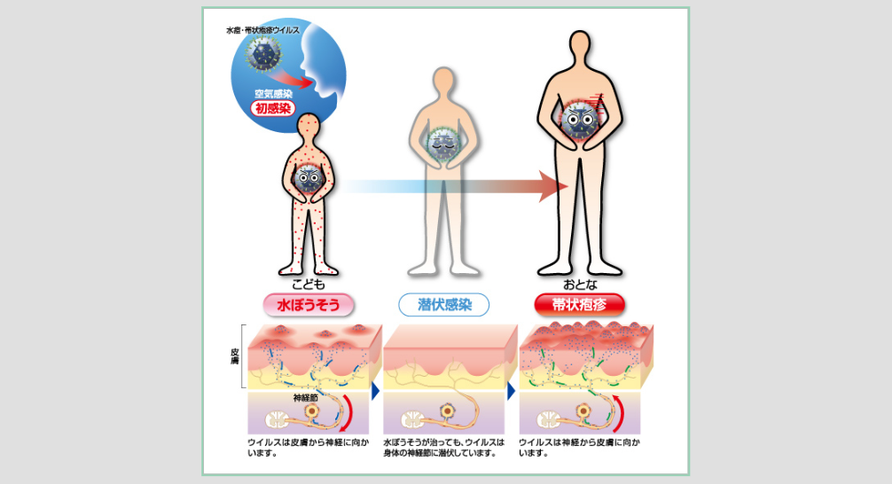 帯状疱疹の原因 水痘ウイルスの再活性化