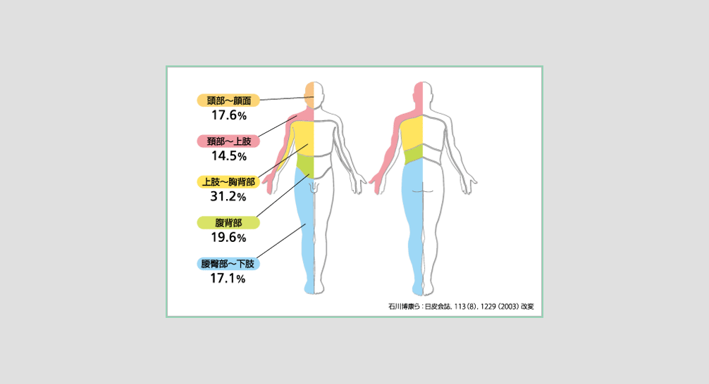 帯状疱疹の皮疹例
