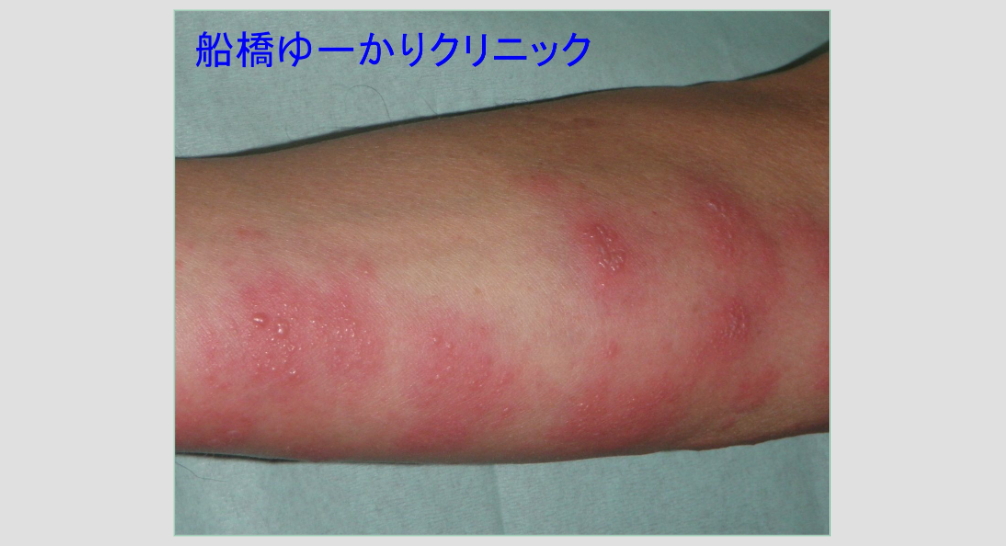 右上肢帯状疱疹 治療前