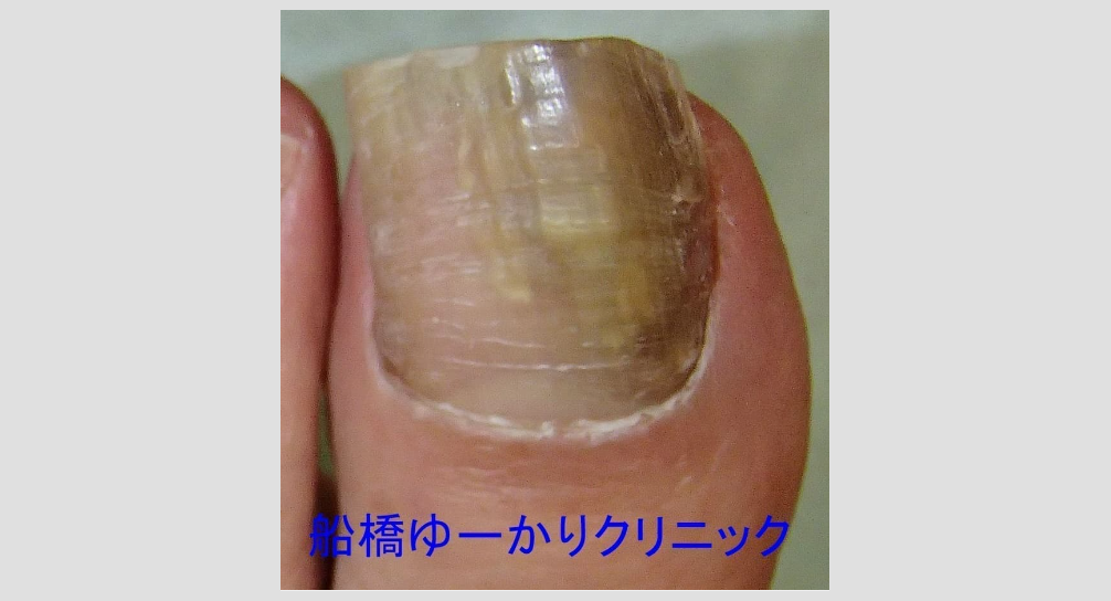 爪白癬の画像
