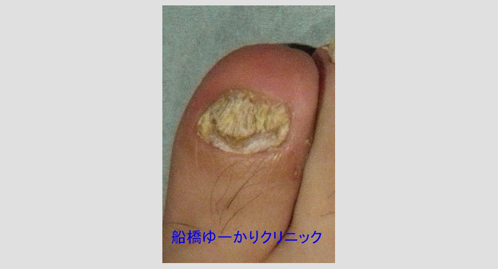 爪白癬 治療前