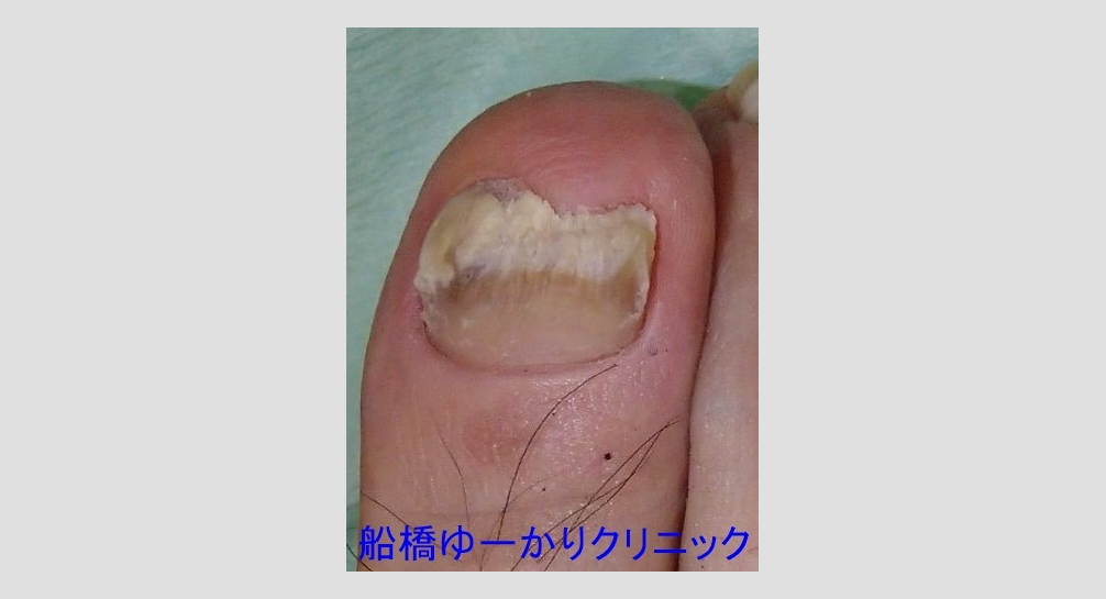 爪白癬 治療1年後