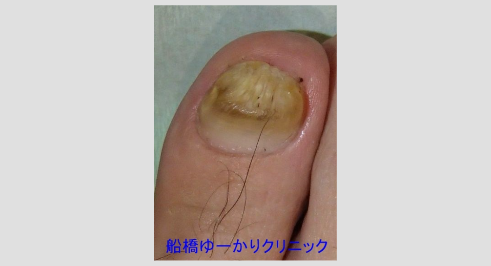 爪白癬 治療2年後