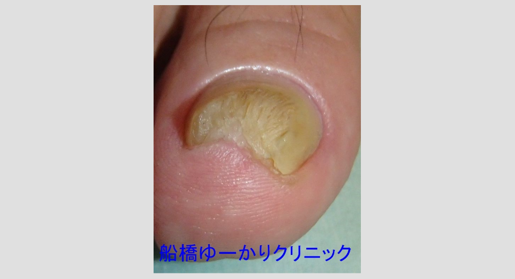 爪白癬 治療3年後