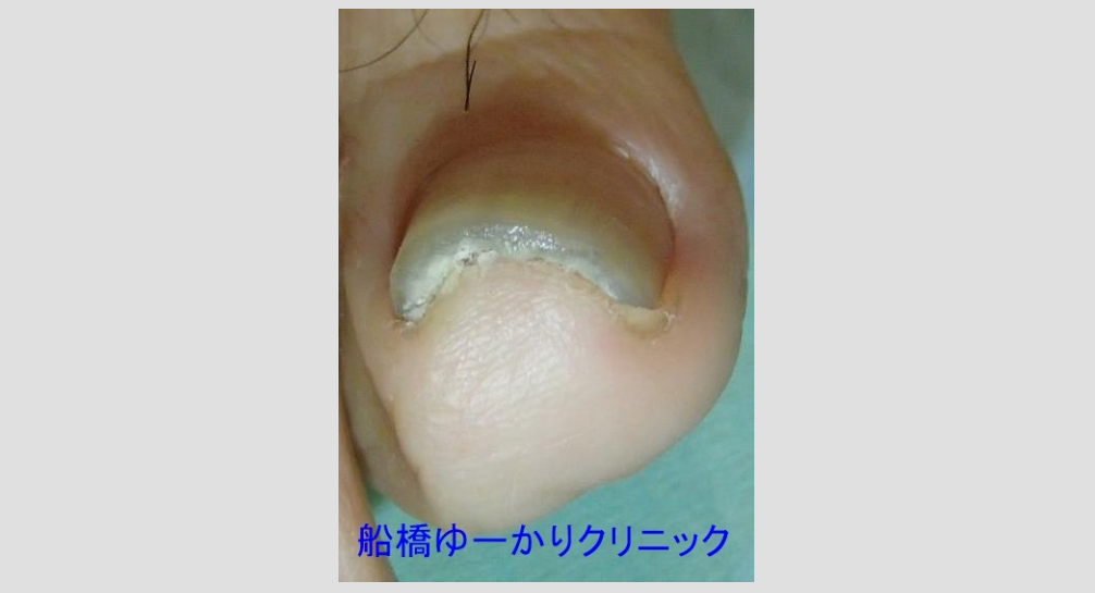 爪白癬 治療4年後