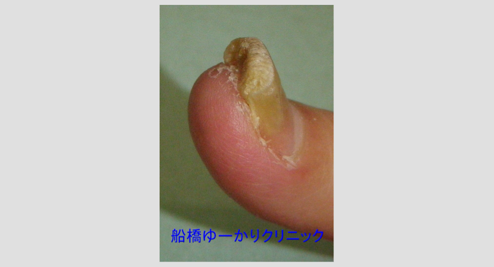 爪白癬 治療前 側面
