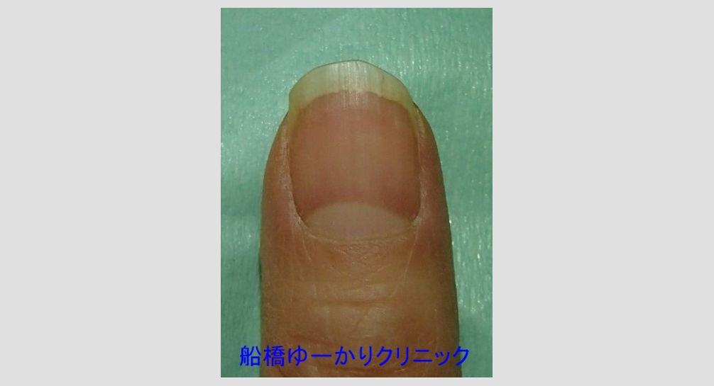 爪白癬 治療5年半後 正面