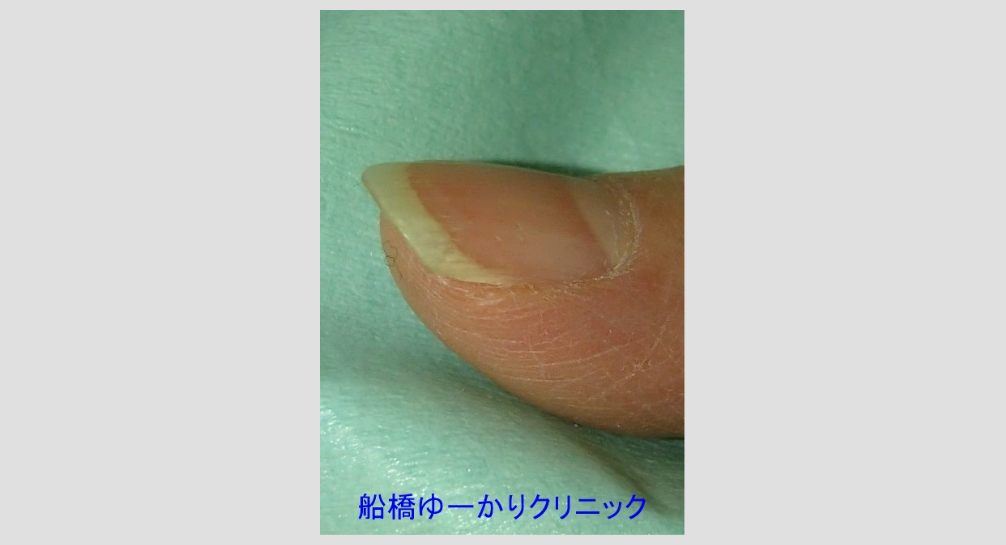 爪白癬 治療5年半後 側面