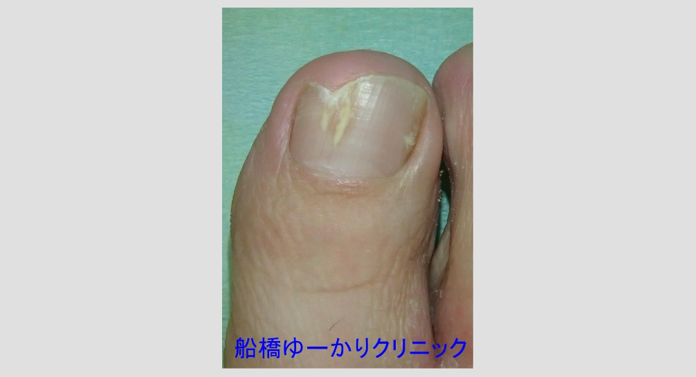 巻き爪 治療開始前