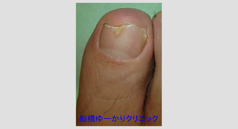 巻き爪 治療2ヶ月後