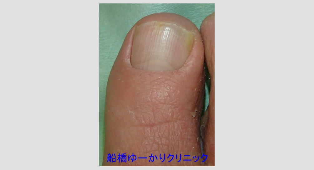 巻き爪 治療4ヶ月後