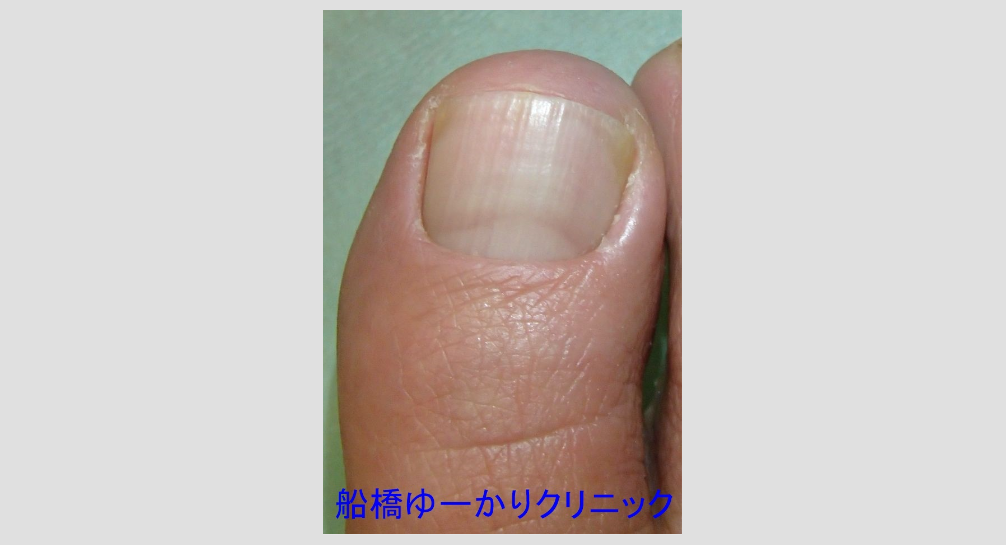 巻き爪 治療5ヶ月後