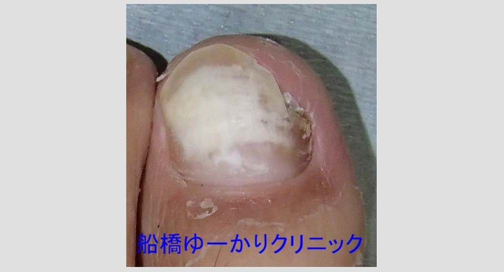 爪白癬の画像