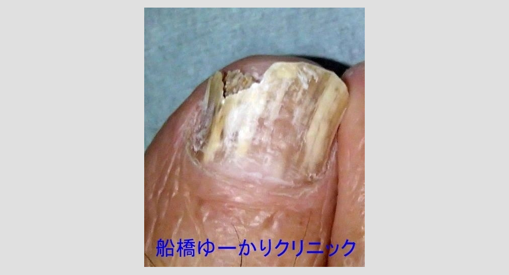 爪白癬の画像