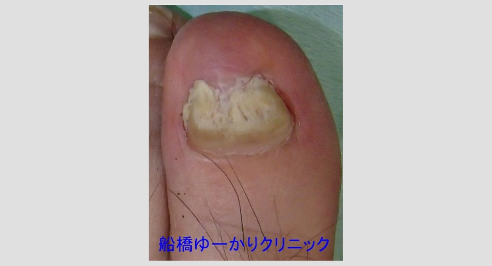 爪白癬 治療1年後