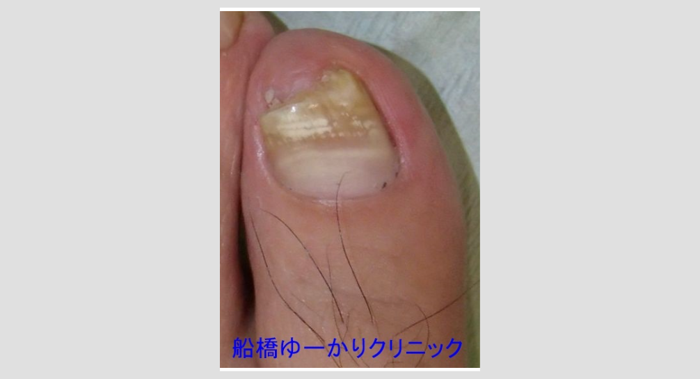 爪白癬 治療2年後