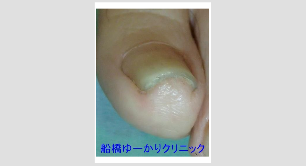 爪白癬 治療4年後