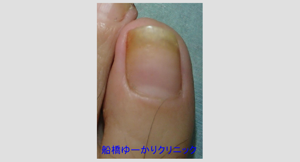 爪白癬 治療5年後