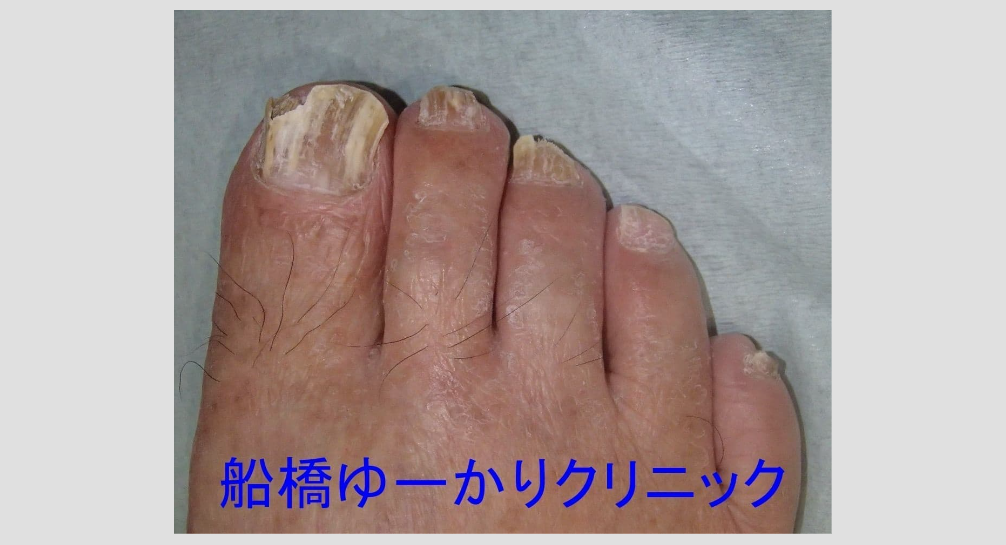爪白癬 治療前