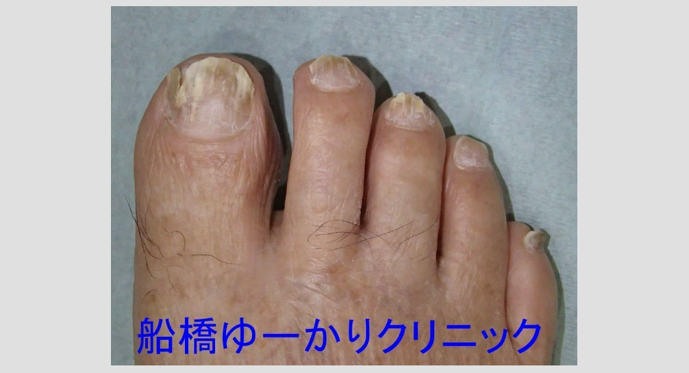 爪白癬 治療3ヶ月後