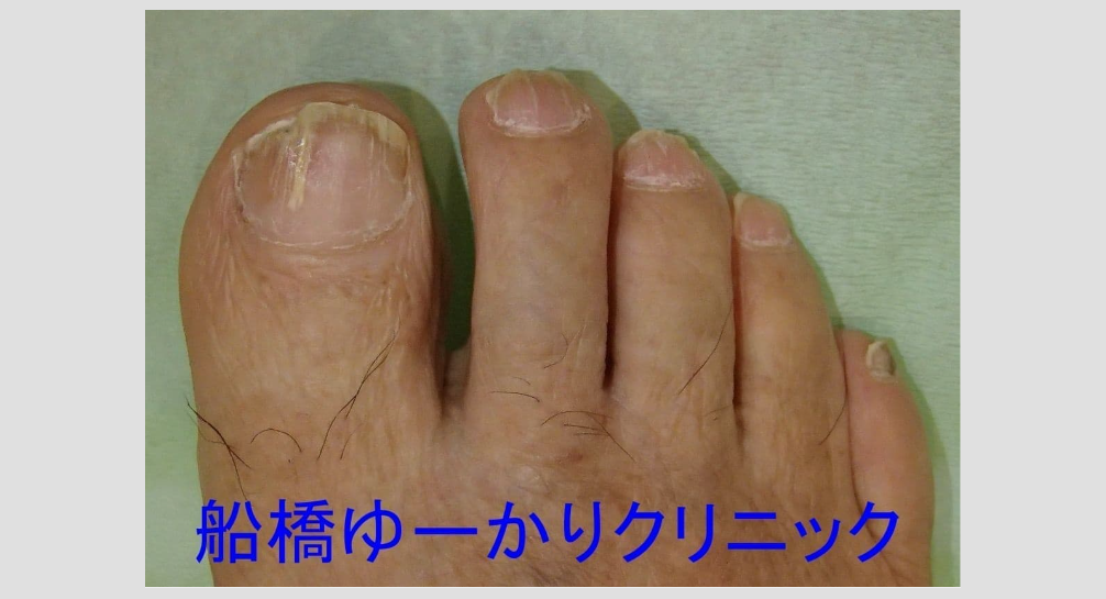 爪白癬 治療7ヶ月後