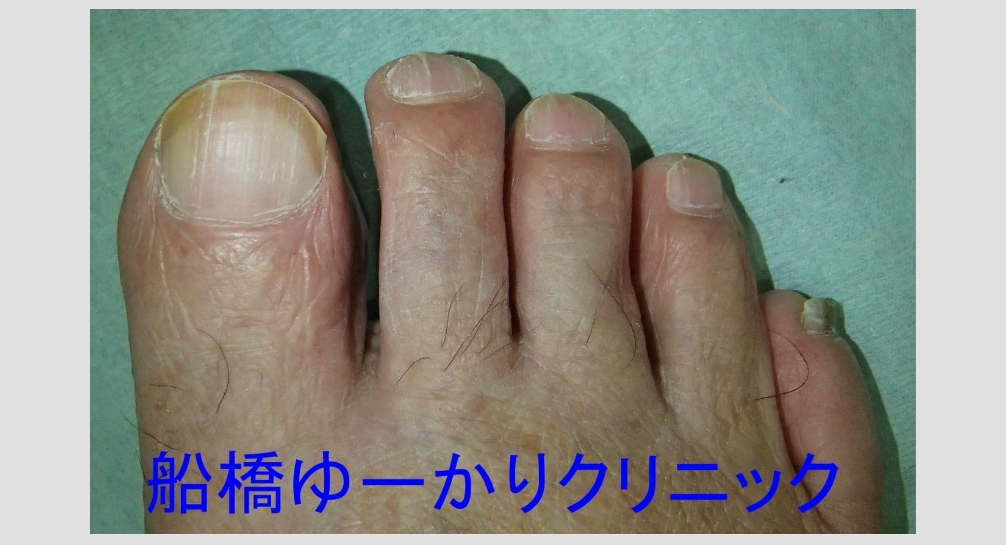 爪白癬 治療1年後