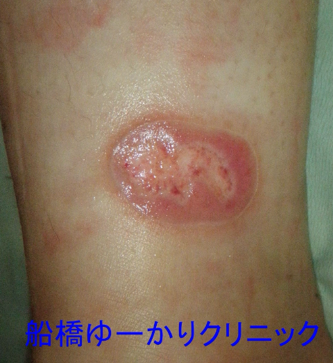 湯たんぽによる低温やけど